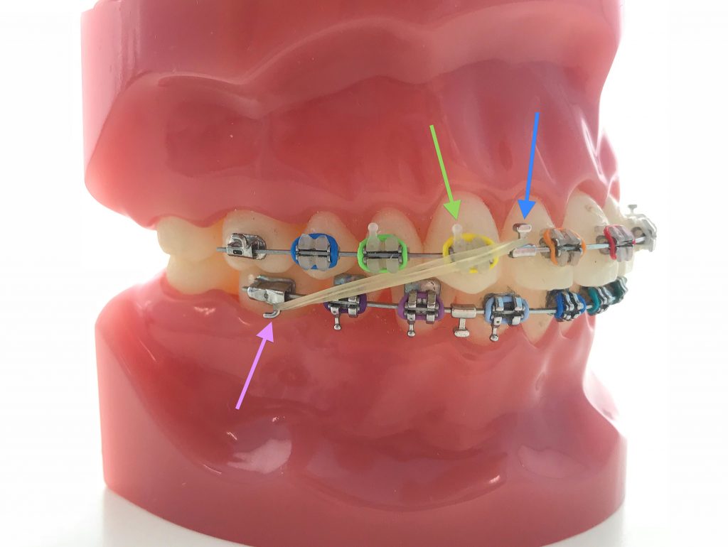CLASS II ELASTICS About Braces