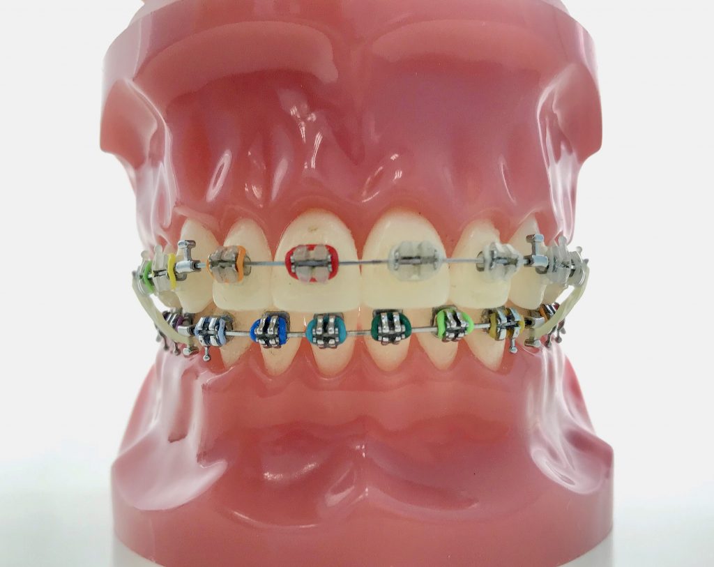 CLASS III ELASTICS About Braces