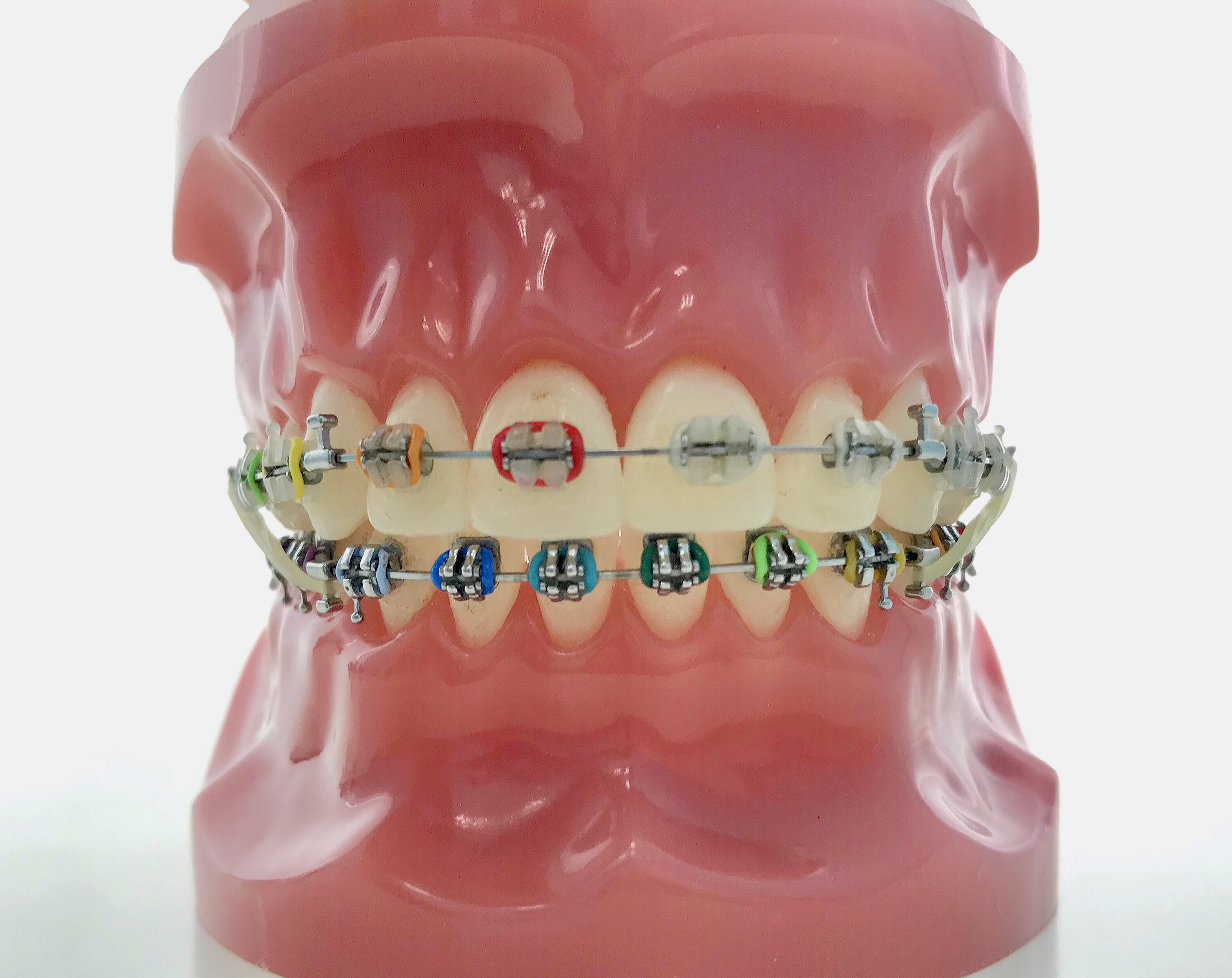 CLASS III ELASTICS About Braces