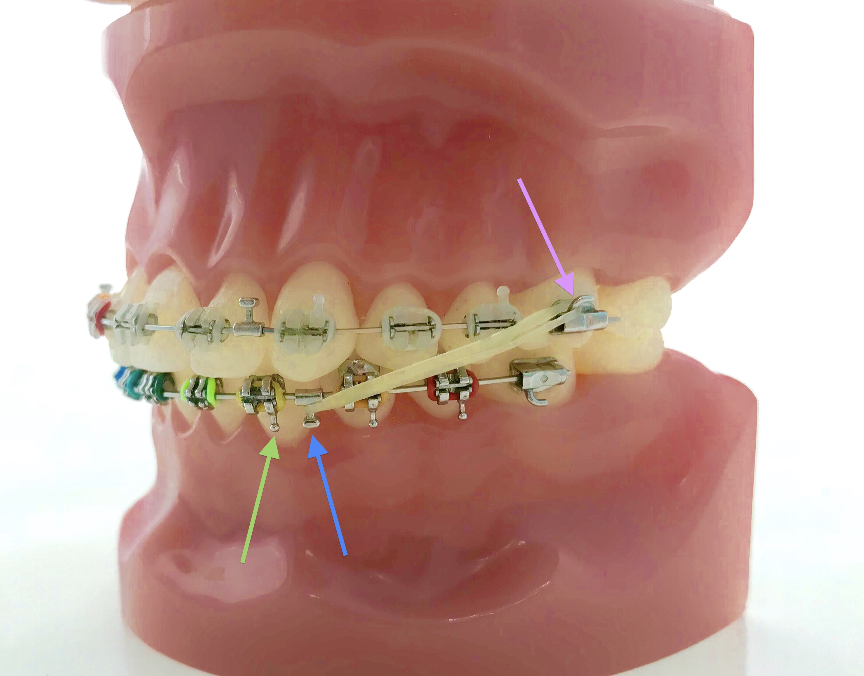 Class III Elastics About Braces