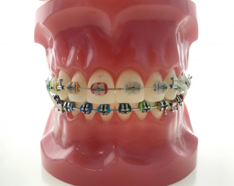 CLASS II LEFT CLASS III RIGHT ELASTICS | About Braces