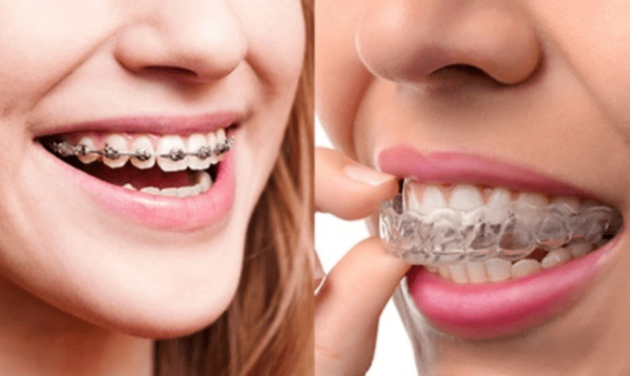 traditional braces vs invisalign