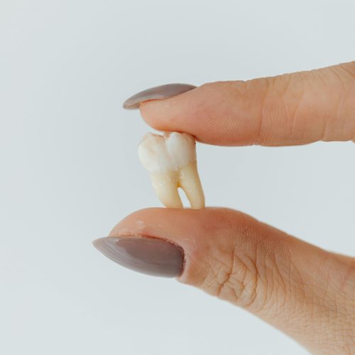 woman holding an extracted tooth