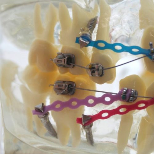 dental teeth model showing temporary anchorage device aka TAD