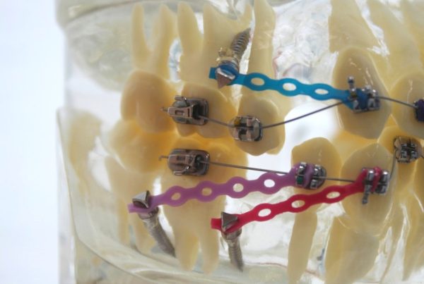 dental teeth model showing temporary anchorage device aka TAD