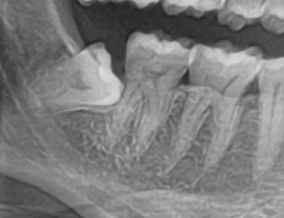 DO WISDOM TEETH MAKE OTHER TEETH CROOKED?