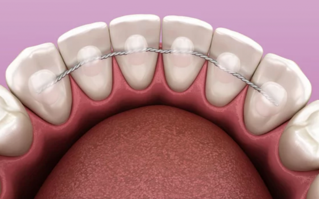 A Complete Guide to Braces Treatment in Singapore