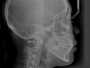 lateral cephalogram