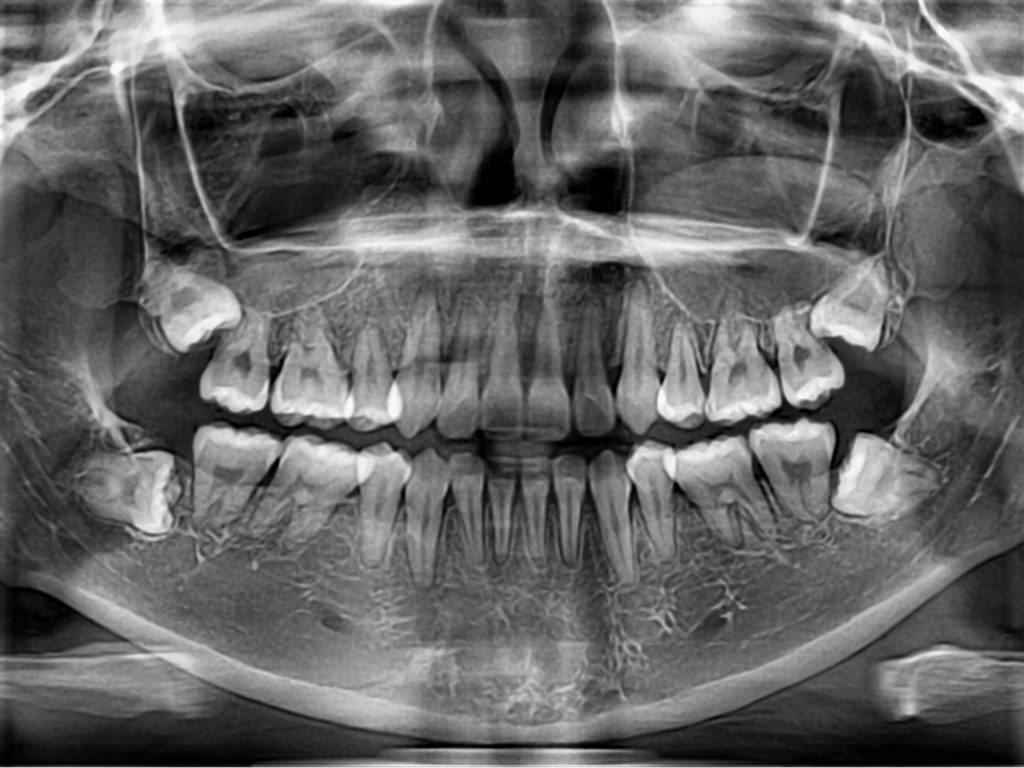 orthopantomagram x-ray