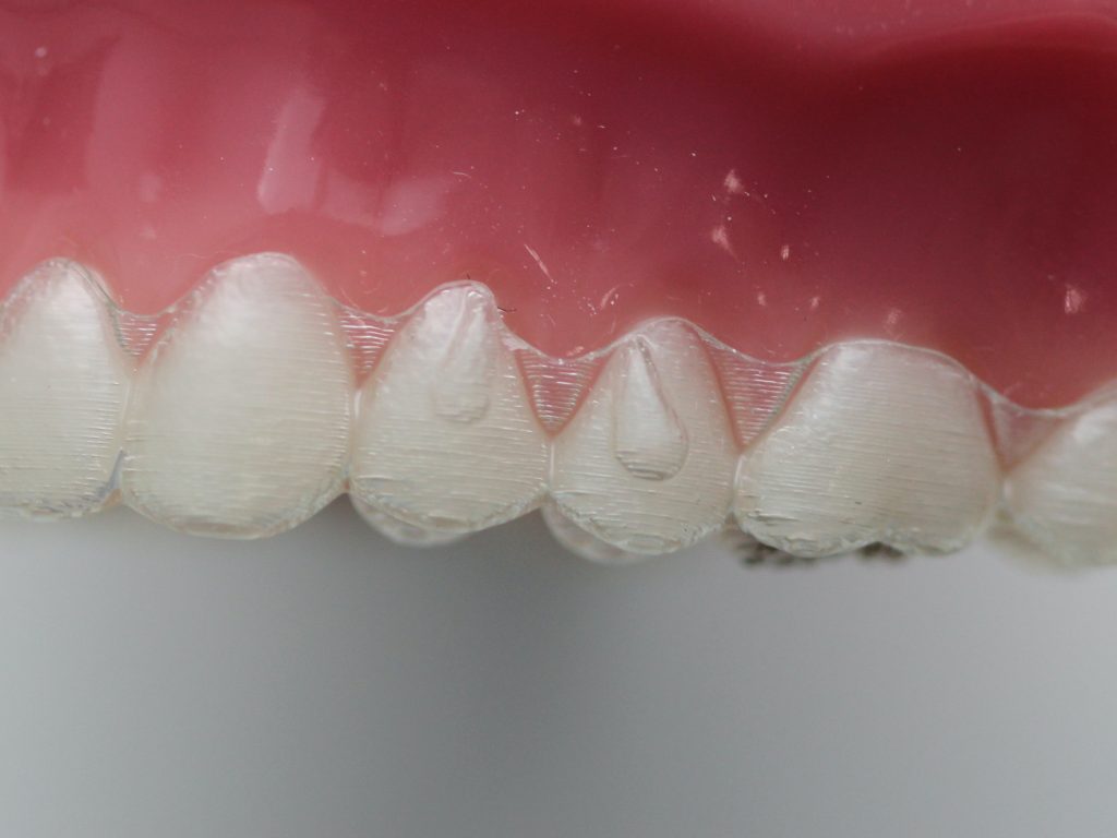 Invisalign attachments