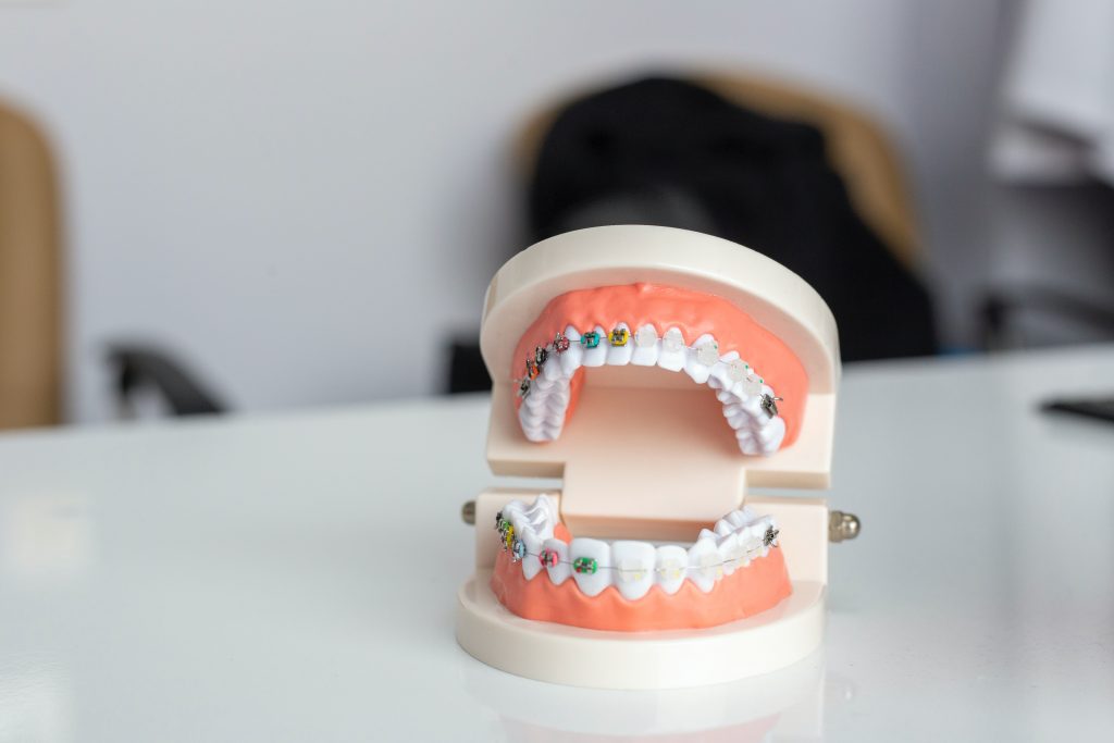 metal and ceramic braces teeth model