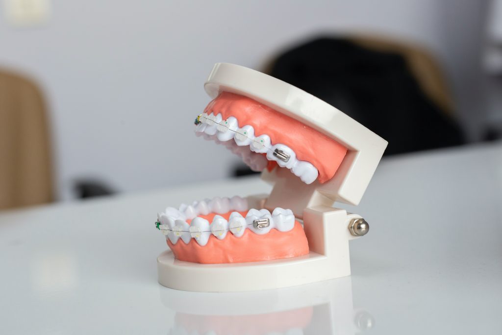 model of ceramic braces with tooth coloured donuts