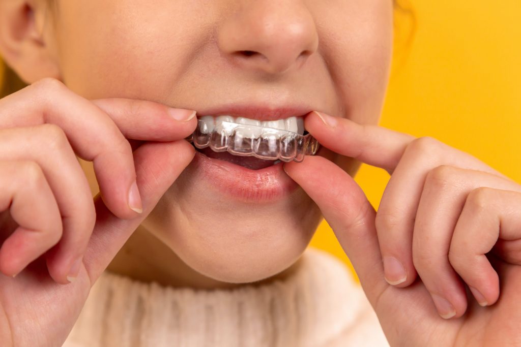 putting on clear aligner