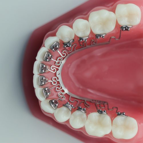 brava on lower teeth (model)