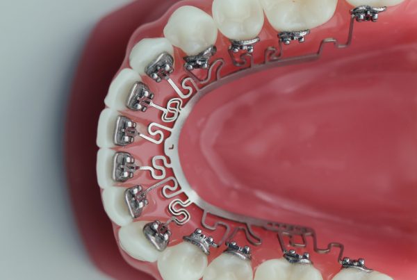 brava on lower teeth (model)