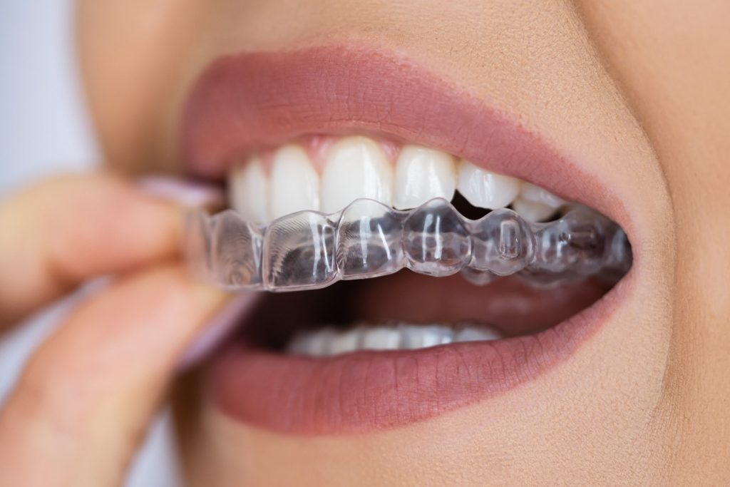 invisible braces - clear aligners