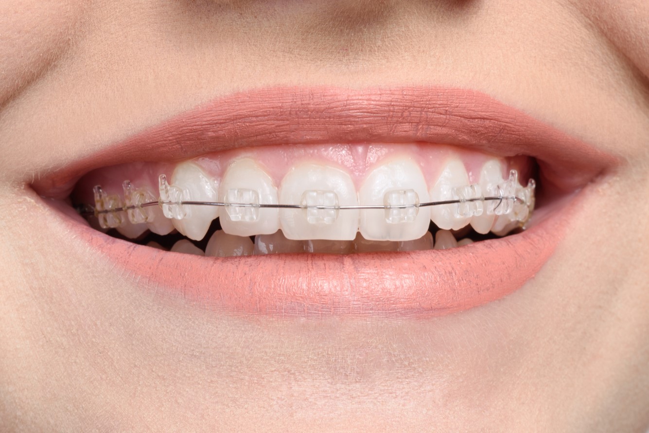 Everything You Need to Know about Ceramic Braces