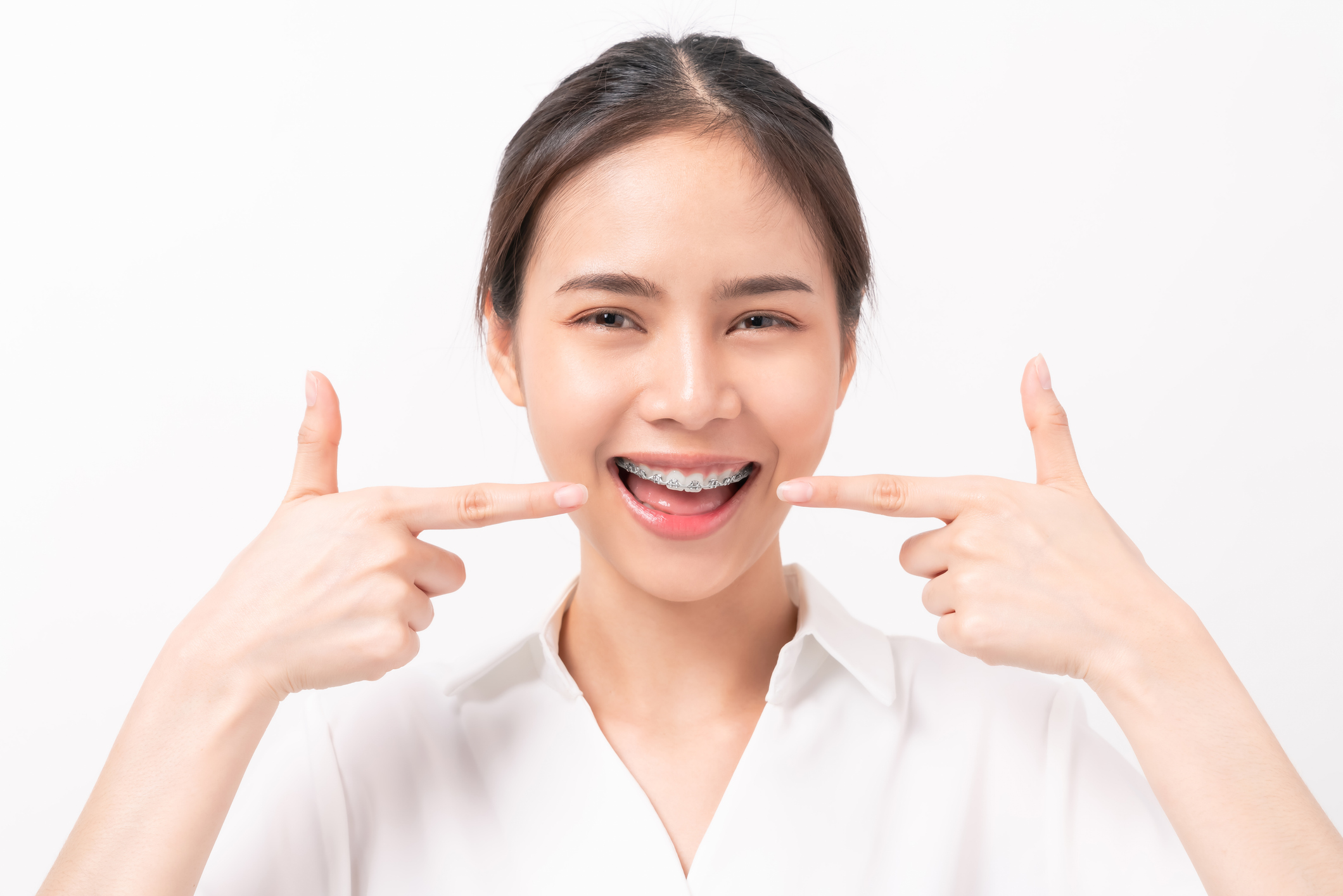 5 Facts about Self-ligating Braces: The Basics You Should Know