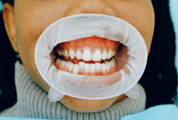 patient with lip guard showing malocclusion of teeth